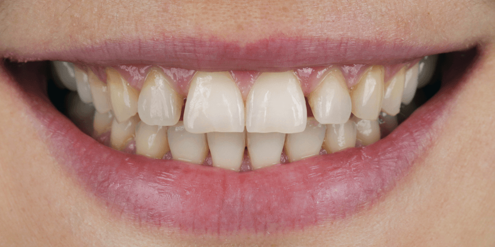 Periodoncia en la clinica dental en Puerta de Toledo