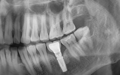 Implantes dentales en Lanzarote: Todo lo que necesitas saber antes de decidirte