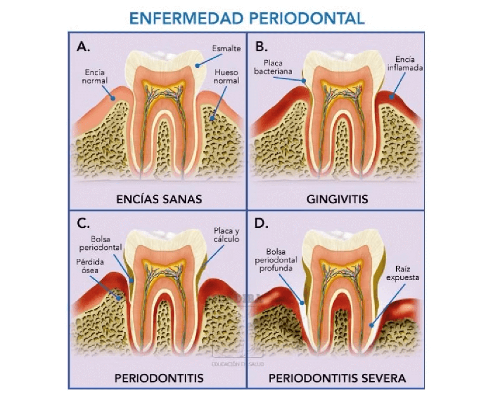 gingivitis y periodontitis