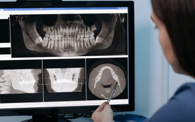 Cirugía guiada sobre implantes: cómo planificar un implante dental con más precisión