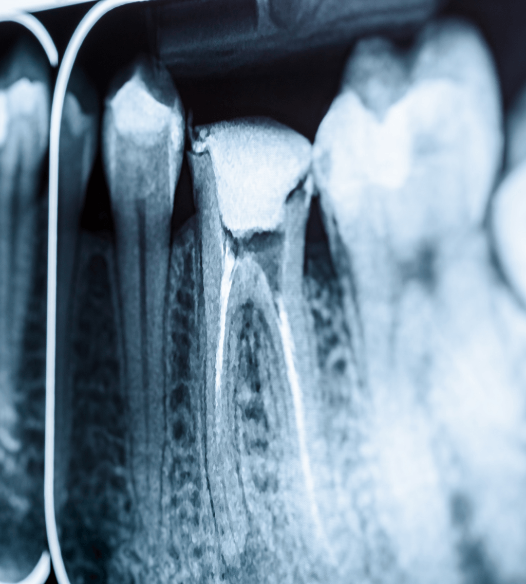 Radiografía dental para valorar el estado de las raíces antes de una endodoncia
